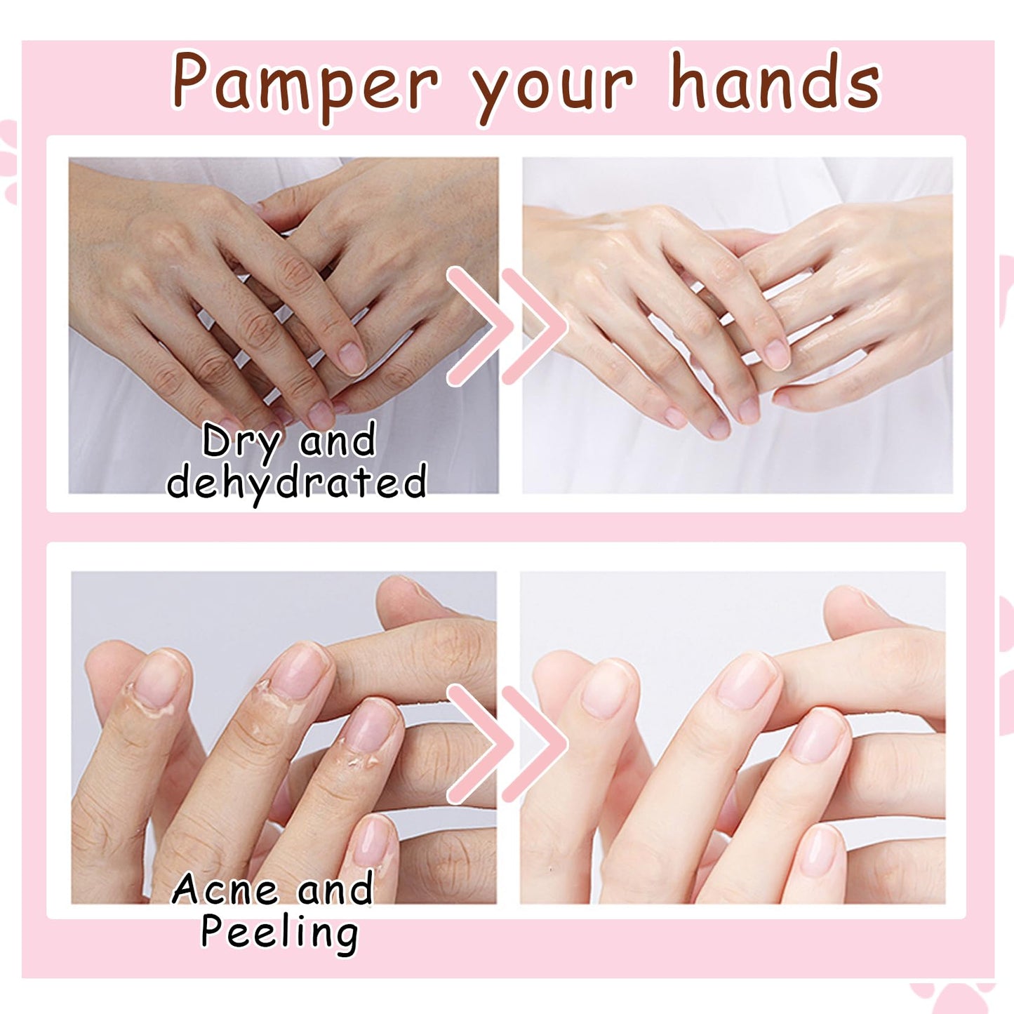 DWDiWen Hand Masks, 6 Pairs Hydrating Exfoliating Hand Peeling Mask, Smooth Hand Masks Moisturizing Gloves Overnight for Dry, Rough, Cracked Hands, Hand Skin Moisturizer Glove for Women Men(E