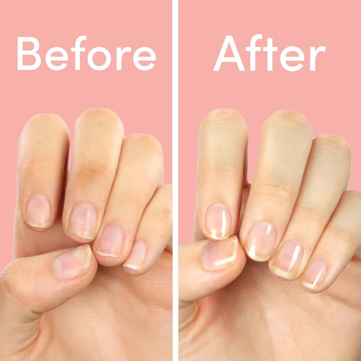 ella+mila "First Aid Kiss" Nail Strengthener and Growth treatment- Nail Repair Solution & Growth Treatment for Thin, Brittle & Damaged Nails - Nail Hardener with Vitamin E (0.45 fl oz)